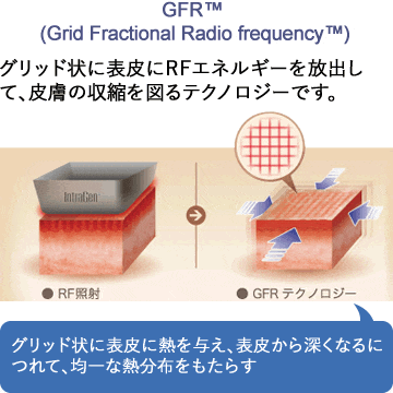 GFR テクノロジーを説明しているイラスト